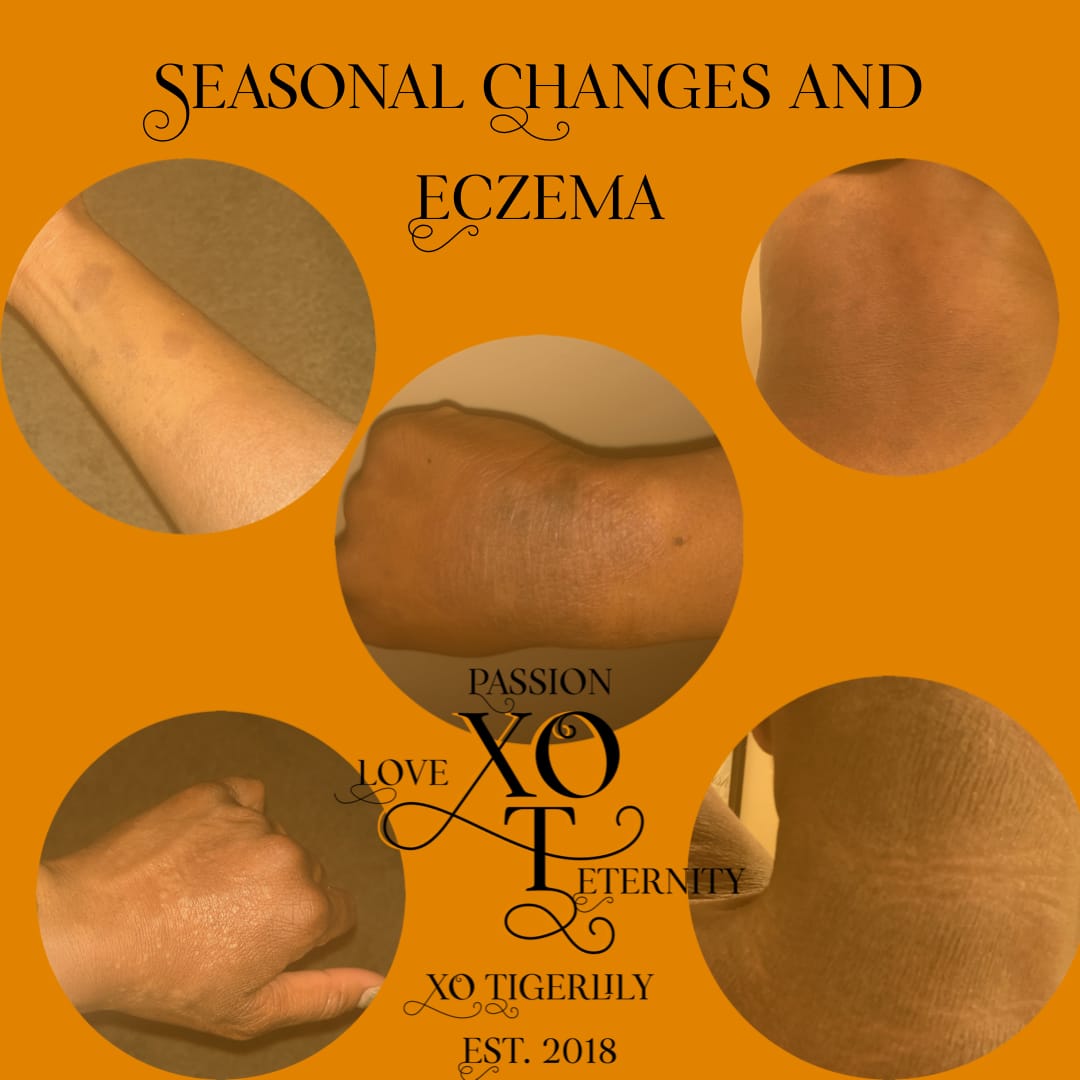 Seasonal Changes and Eczema - XO Tigerlily